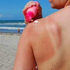 Tomatoes Milk And Potatoes Can Treat Sunburn W24