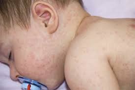 Trẻ Bị Nổi Mề Đay Tắm Lá Gì Vừa An Toàn, Vừa Nhanh Héte