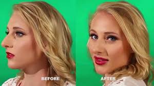 If you are treating gummy smile with the botox this counts as 1 area, making it €250. How To Correct A Gummy Smile Instantly Candylipz