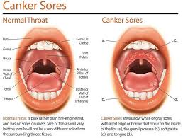 They form inside your mouth — on or under your tongue, inside your cheeks or lips, at the base of your gums, or on your soft palate. First I Want To Clarify That Canker Sores And Cold Sores Are Different Cold Sores Appear Outside Of The Mouth Usu Canker Sore Mouth Ulcers Canker Sore Remedy