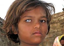 Children can get a certain type of cancer called retinoblastoma. White Spot On Eye Causes Symptoms And Treatment