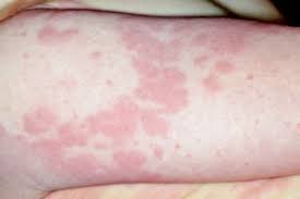 Often, this occurs in the cheeks, and may look like flushing, though it will not include any sweating. Allergies Symptoms Nhs