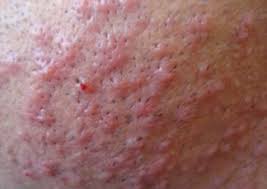 Most often, hair that is shaved, waxed, or plucked will grow back through the skin and toward. Ingrown Hair On Scrotum Testicle Sack Symptoms Pictures Causes Get Rid Removal Treatment