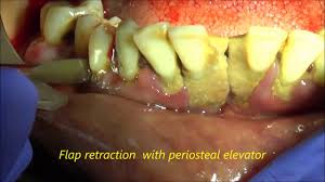 In the case where a full mouth extraction is necessary, know that your cat can still lead a happy and healthy life including properly eating. Lower Full Mouth Extraction With Alveoloplasty Youtube