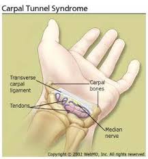 Tricks Of The Trade Non Surgical Option For Healing Carpal Tunnel Syndrome Carpal Tunnel Natural Remedies For Arthritis Carpal Tunnel Syndrome