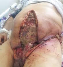 It is primarily a clinical diagnosis. Fournier Gangrene Wikidata
