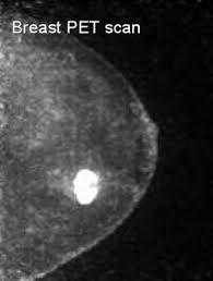 Identify the correct area for. Pet Scan And Breast Cancer Diagnosis Moose And Doc