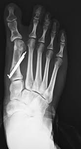Image result for Hallux Varus