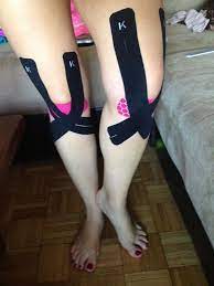 Patella Femoral Syndrome