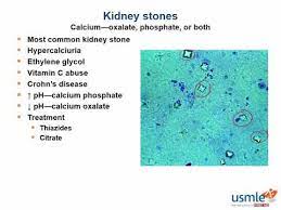 Usmle Rx Express Video Of The Week Kidney Stones Youtube
