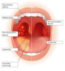 Halsschmerzen Golamir 2act Aboca