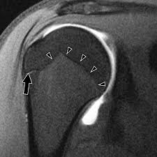 Image result for Humerus Growth Plates