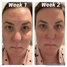 Calm redness with the Series 2 Red Light Mask for faster skin recovery.  @becky_wren , runner up of the 2025 before and after competition.