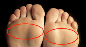 Image result for Metatarsalgia