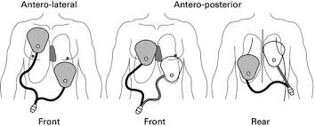 All versions of defibrillators usually consist of two paddles or stickers that are placed on the patient's body in a very specific position in order to pass the desired amount of current through the patient's heart. Cardioversion And Defibrillation Thoracic Key