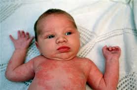 Susu apa yang sesuai untuk anak ekzema alah produk tenusu. Apa Yang Perlu Anda Tahu Mengenai Eczema