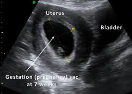 If you think you might be pregnant and don't know what to do next, we can help. Ultrasound Pregnancy Test Near Me Pregnancy Test