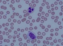 Image result for Hyperviscosity Syndrome