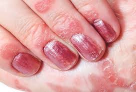 What are black lines on nails? Nail Psoriasis Treatment Home Remedies Causes Symptoms
