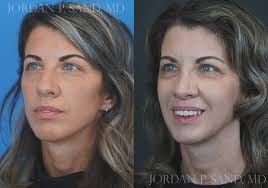 Revision Rhinoplasty