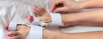 But there are some measures you can take to be more comfortable or to slow a bunion's progression, says podiatrist dina stock, dpm. Bunion Surgery Johns Hopkins Medicine