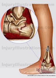 Image result for Calcaneus Compression Fracture