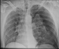 Pneumothorax symptoms comprise of difficulty in breathing and loss of lung function. Left Tension Pneumothorax Radiology Case Radiopaedia Org