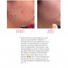 Cependant, il ne vise pas à donner des conseils médicaux et il. Masque Anti Points Noirs Ou Pores Dilates Peau Neuve