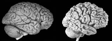 Resultat d'imatges de alzheimer