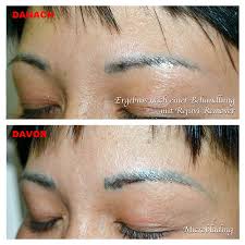 The saline solution is the main component to this procedure; Microblading And Tattoo Removal For Brows Swanky Lash And Skin Studio