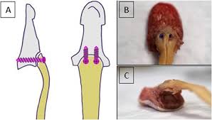 Doctors perform tendon repair surgery to fix a tendon injury. Introduction Of A New Repair Technique In Bony Avulsion Of The Fdp Tendon A Biomechanical Study Scientific Reports
