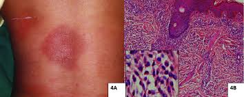 Image result for Urticaria pigmentosa children