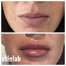 At ljc, our juvéderm® prices start at $458 for the smallest syringe. Our Work Skinlab Injectables