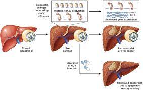 The virus, called the hepatitis c virus or hcv for short, is just one of the hepatitis viruses. Indelibly Stamped By Hepatitis C Virus Infection Persistent Epigenetic Signatures Increasing Liver Cancer Risk Gastroenterology