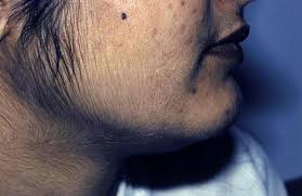 It's normal for women's bodies to make these, and low levels don't cause excess hair growth. Hirsutism