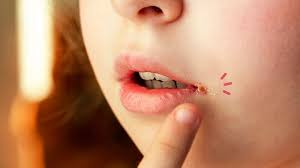 Maybe you would like to learn more about one of these? 11 Cara Mengobati Luka Di Sudut Bibir Secara Alami Ampuh Orami