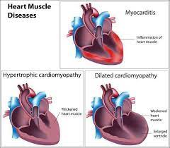 Myocarditis can increase the risk for scar tissue developing on the heart, a heart attack, heart failure or stroke. Heart Muscle Diseases Myocarditis Hypertrophic Cardiomyopathy Dilated Cardiomyopathy Photo Curtesy Emt Paramedic Fb