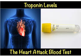 Troponin Levels The Heart Attack Blood Test Myheart Net