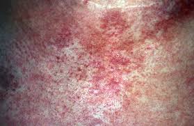 I'll find out from my biopsy they are removing the entire node. Breaking Out In A Rash Could Be A Sign Of Cancer Here S How Tell If You Are At Risk