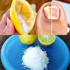 Nail Fungus Removal: 100% Natural Treatment For Toenail Fungus Must express  something to keep getting my recipes.... Thank you😍 Recipe in The First  (c.o.m.m.e.n.t ).👇 | Facebook