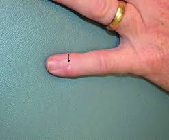 Its discovery usually happens after an advanced stage has been reached. Tumors Of The Nails Skin Disorders Msd Manual Consumer Version