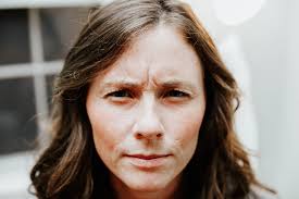 Before and After Using Dysport