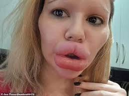 Andrea Ivanova claims, "I have the biggest lips in the world and plan to  make them even larger with more filler," despite fans fearing they might  "burst."