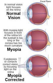 Myopia Nearsightedness Symptoms Causes Treatment How To Relief Eye Health Facts Eye Exercises Eye Facts