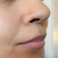 Hypoallergenic Nose