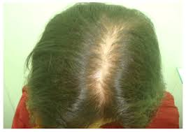 7 chemicals that cause hair loss. A Scientific Hypothesis On The Role Of Nutritional Supplements For Effective Management Of Hair Loss And Promoting Hair Regrowth