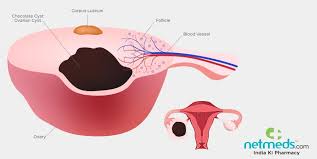 This is known as an endometrioma. Chocolate Cysts Causes Symptoms And Treatment