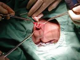 Berkhatan atau berkhatan adalah satu perkara yang baik untuk kesihatan. Anak Fitrah Www Hamidarshat Net