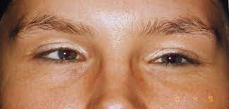 Schielen Auge Online