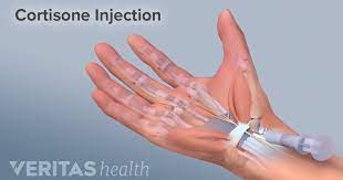 You might be better than me. Cortisone Injections Steroid Injections
